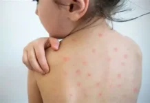 El sarampión está resurgiendo con fuerza. No estamos preparados