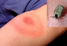 Sube a 5 las muertes por rickettsiosis