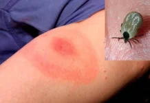 Planean acciones de contención de casos de rickettsia en Ciudad Juárez