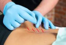 ¿La punción seca realmente alivia el dolor?