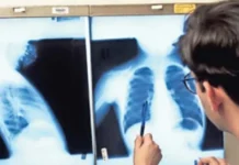 Acumula Chihuahua 27 muertes por tuberculosis