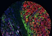 Técnica experimental para reducir la metástasis del melanoma y mejorar la acción de la inmunoterapia