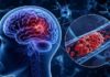 Técnica de imagen no invasiva que permite localizar por vez primera los microtrombos que agravan el alzhéimer