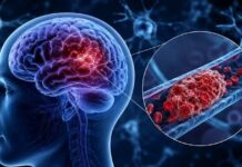 Técnica de imagen no invasiva que permite localizar por vez primera los microtrombos que agravan el alzhéimer